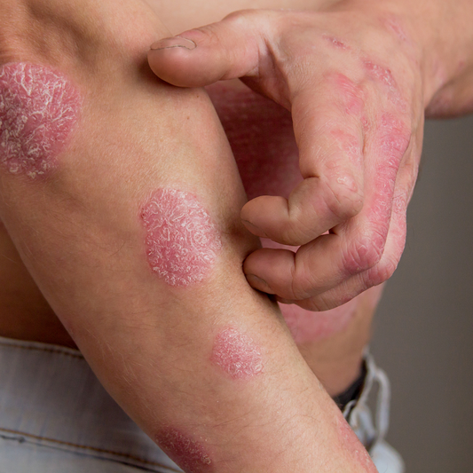 Caring for Eczema-Prone Skin: The Power of an Anti-Inflammatory Diet