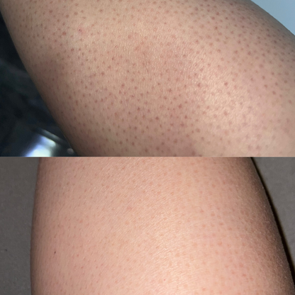 EXFOLIATING GLOVE – Remove Dead Skin & Blackheads